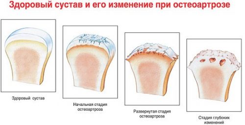 Степени разрушения сустава при остеоартрозе