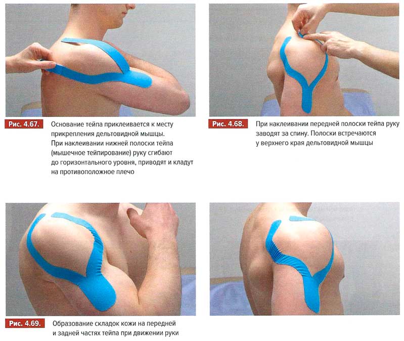 Тейпирование дельтовидной мышцы плеча