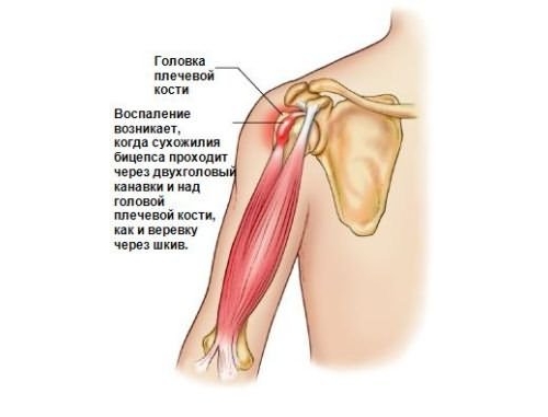 Тендинит сухожилий и мышц плечевого сустава