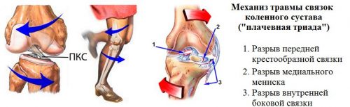 Травмирование связок колена