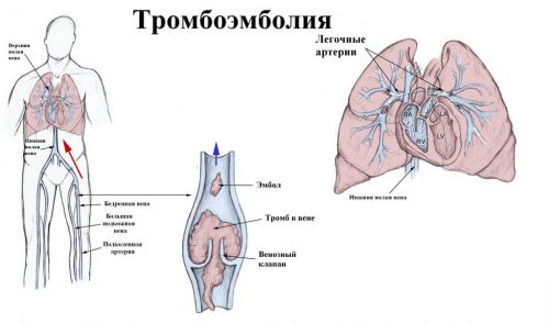 Тромбоэмболия