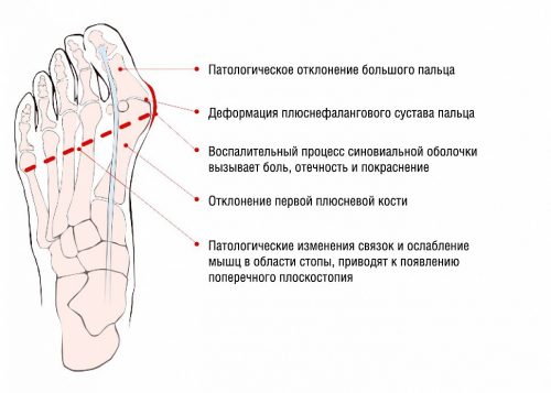 Признаки вальгусной деформации большого пальца стопы