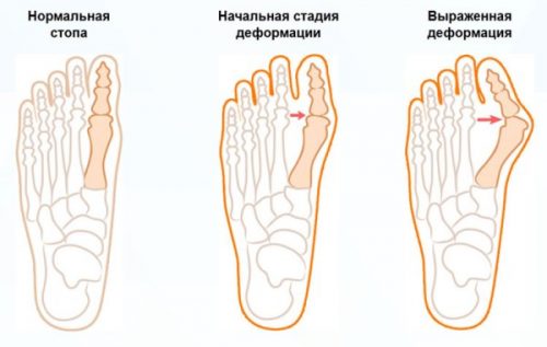 Степени вальгусной деформации большого пальца стопы 