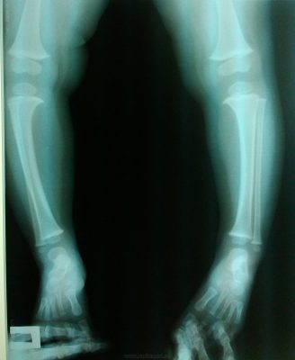 Варусная деформация ног на рентгене