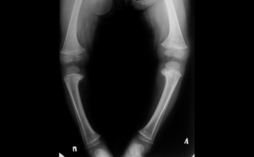 Варусное искривление ног на рентгене