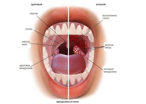 Воспаление миндалин и горла