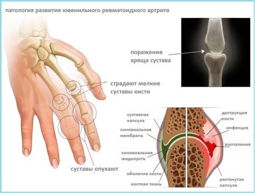 Патология ювенильного ревматоидного артрита