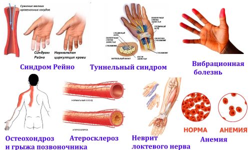 Заболевания — причины онемения рук