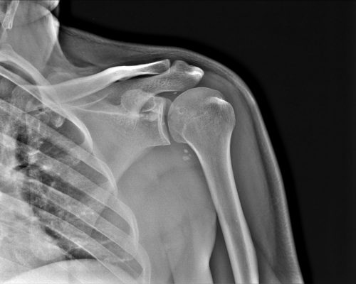 Задняя нестабильность плечевого сустава на МРТ снимке