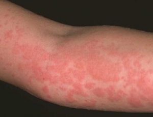 Аллергия на гель