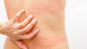 Аллергия на спине или животе