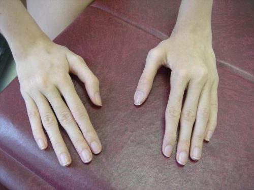 Арахнодактилия пальцев