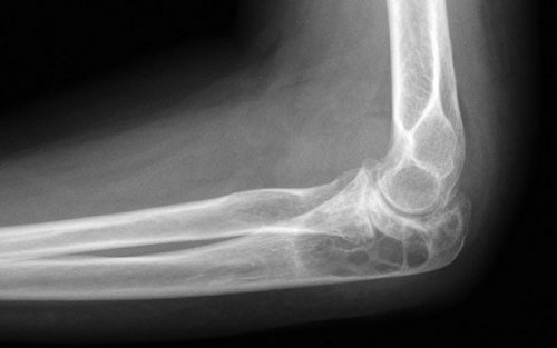 Артрит локтевого сустава на рентгене