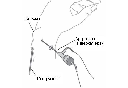 Артроскопия гигромы