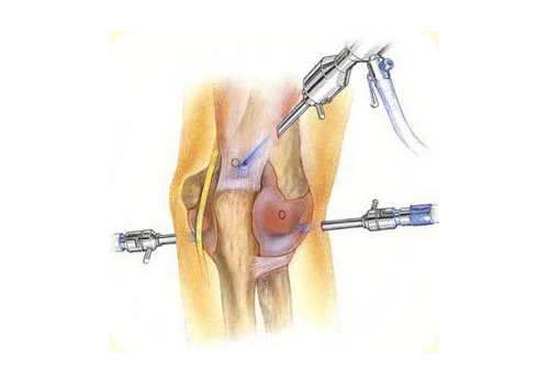 Артроскопия локтевого сустава