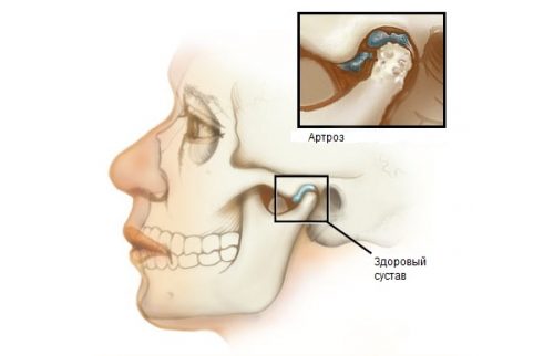 Изменения при артрозе челюстно-лицевого сустава