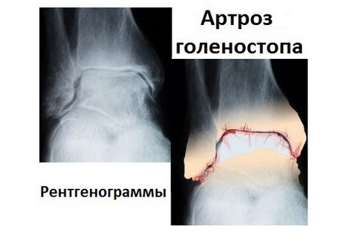 Артроз голеностопного сустава на рентген снимке