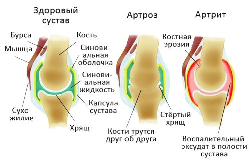 Признаки артроза и артрита суставов