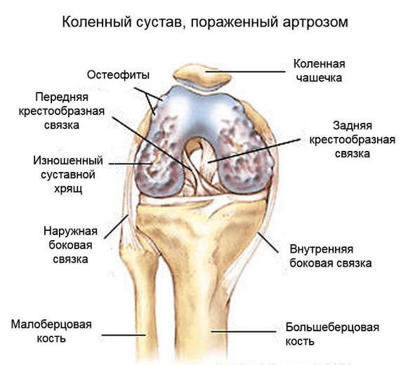 Изменения при артрозе коленного сустава