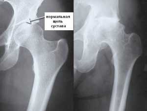Артроз тазобедренного сустава на рентгене