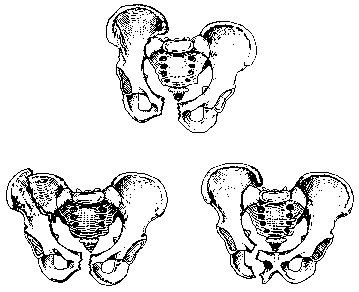 Ассиметрия костей таза
