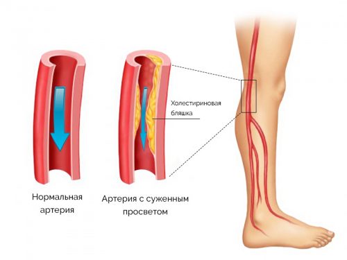 Атеросклероз конечностей