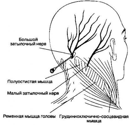 Блокада шейного отдела позвоночника для снижения боли