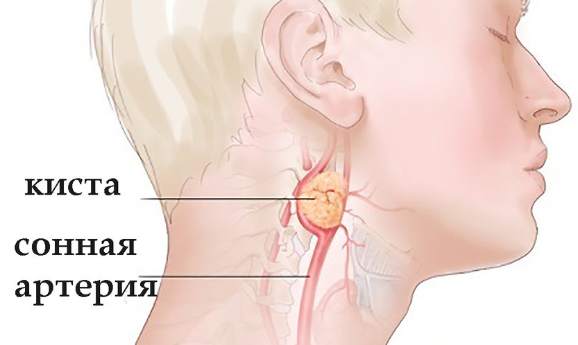 Боковая киста шеи около сонной артерии