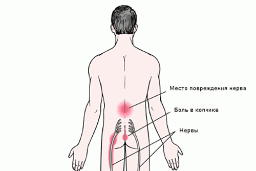 Боль в копчике и ногах при радикулопатии пояснично-крестцового отдела позвоночника