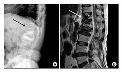 Болезнь Форестье на рентген снимке и МРТ