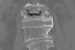 Болезнь Кюммеля на рентген снимке