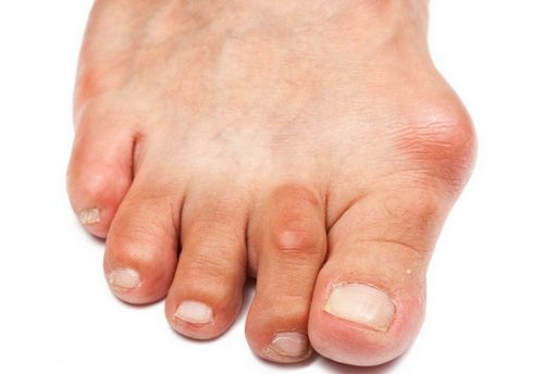 Проблема бурсита большого пальца стопы