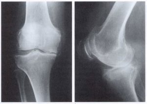 Деформация коленного сустава при остеоартрозе третьей стадии