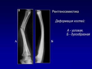 Назначение остеотомии при деформации костей
