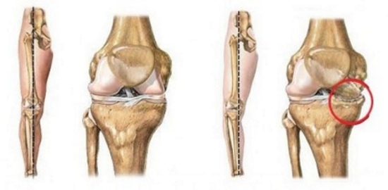 Деформирующий артроз колена