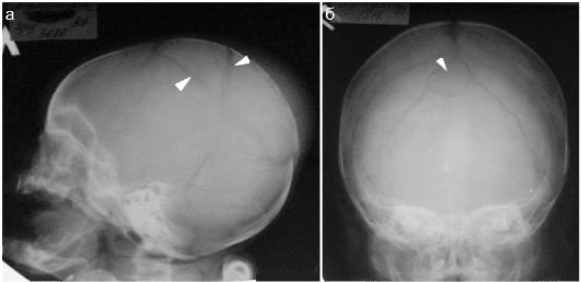 Перелом черепа на рентген снимке