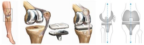Схема эндопротезирования коленного сустава