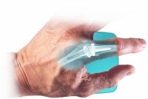 Эндопротезирование пальца рук при артрозе