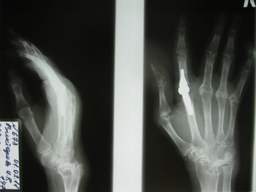 Палец с протезом на рентген снимке