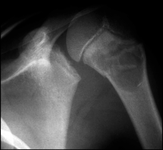 Фиброзная киста плечевого сустава на рентген снимке