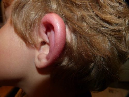 Гематома уха или отогематома