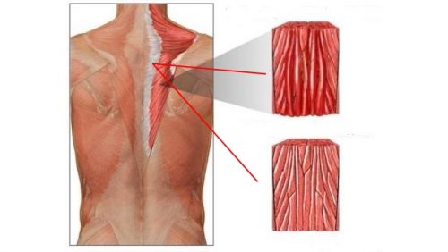 Гипертонус мышц спины