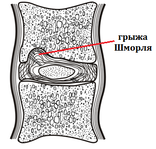 Грыжа Шморля на фоне остеопороза