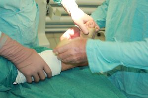 Хирургия вальгусной стопы