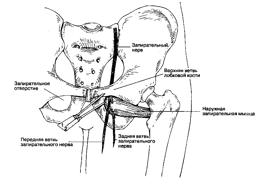 Инъекция или блокада запирательного нерва