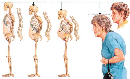 Изменение при остеопорозе у пожилых женщин
