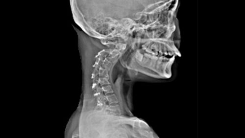 Кифоз шеи на МРТ снимке