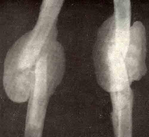 Костная мозоль на рентген снимке