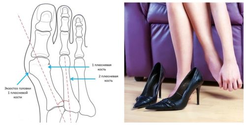 Возникновение косточки на ноге большого пальца стопы