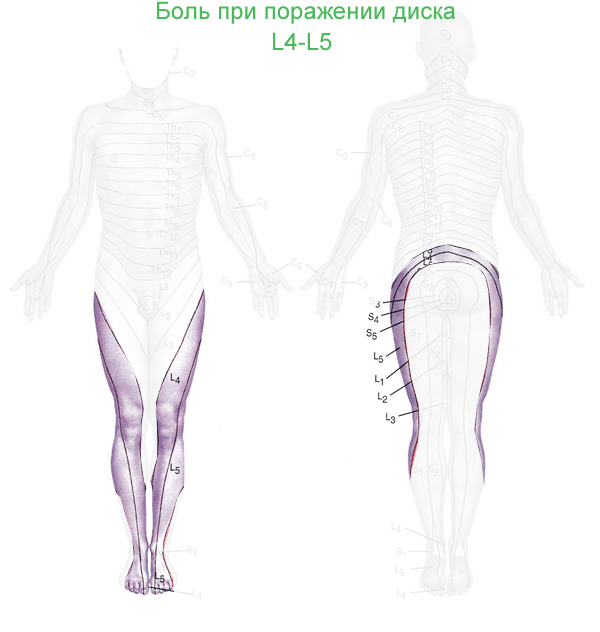Боль в области ног при протрузии дисков l4-l5